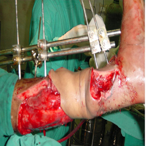 Fracture stabilization of forearm bones