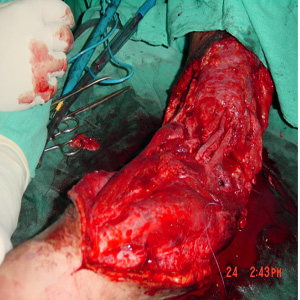 After debridement a healthy clean wound