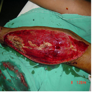Fasciotomy – exposing muscles to remove internal pressure