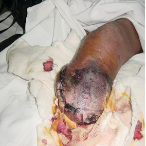 Gangrenous amputation stump
