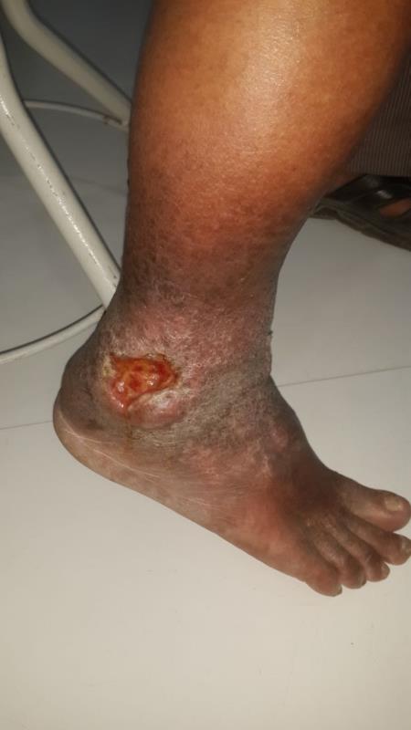 Varicose and more
