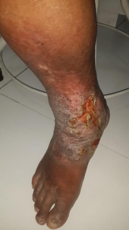 Varicose and more