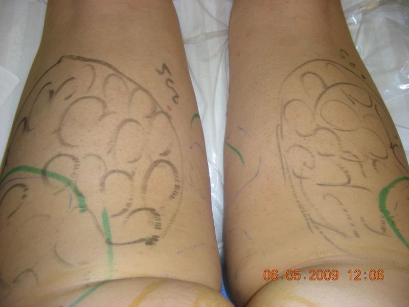 Varicose and more