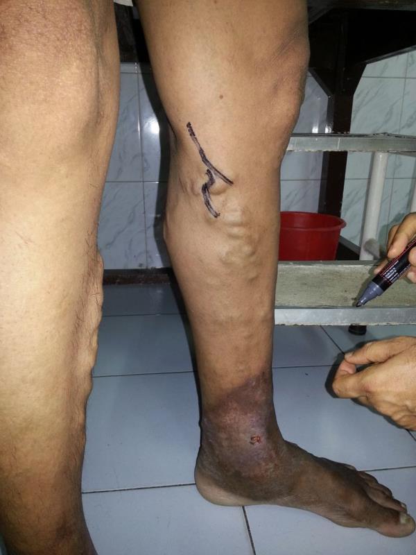 Varicose and more