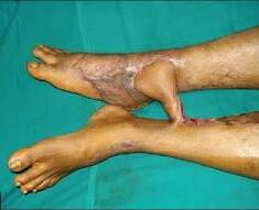 Varicose and more