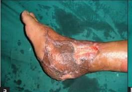 Varicose and more