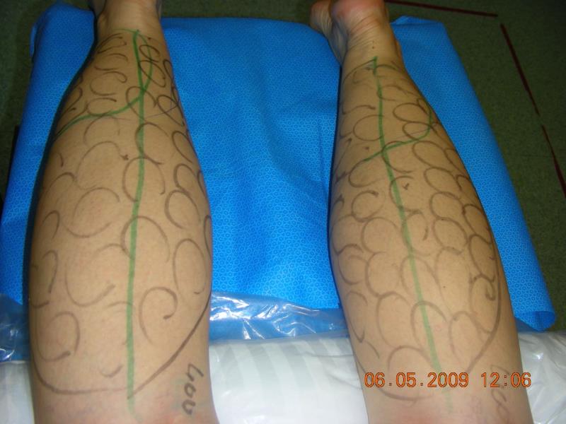 Varicose and more